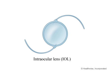 Intraocular lens